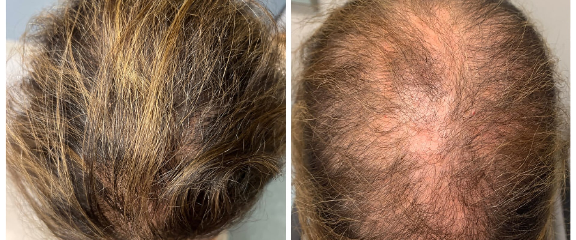 The Most Effective Hair Loss Treatments: What You Need to Know