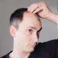Preventing Hair Loss: The Best Lifestyle Changes to Stop Hair Loss