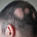 What diseases is hair loss a symptom of?