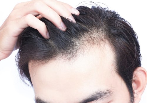 What are the Most Common Causes of Hair Loss? A Comprehensive Guide